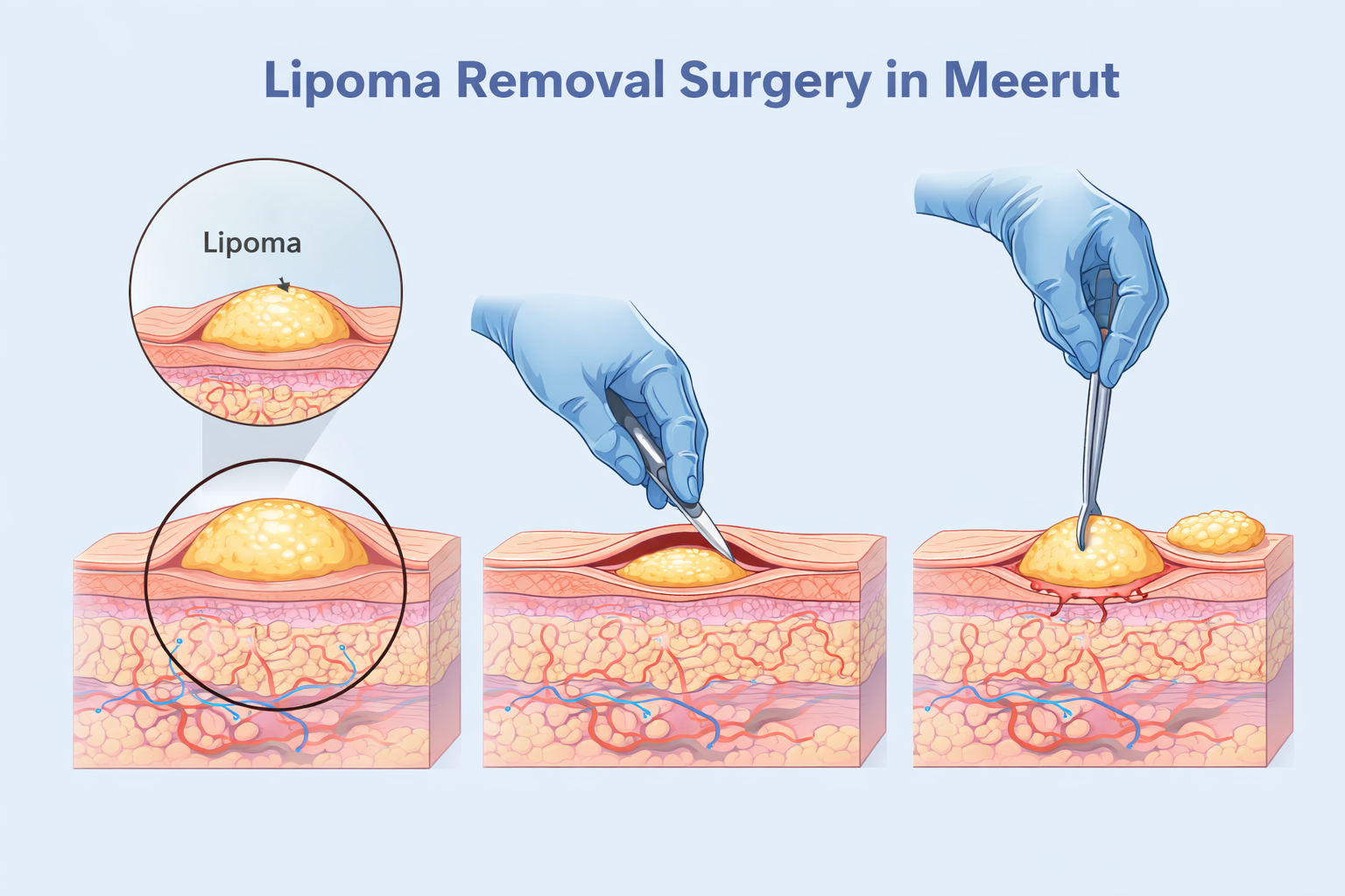 Lipoma Removal Surgery by “Best Plastic Surgeon in Meerut”