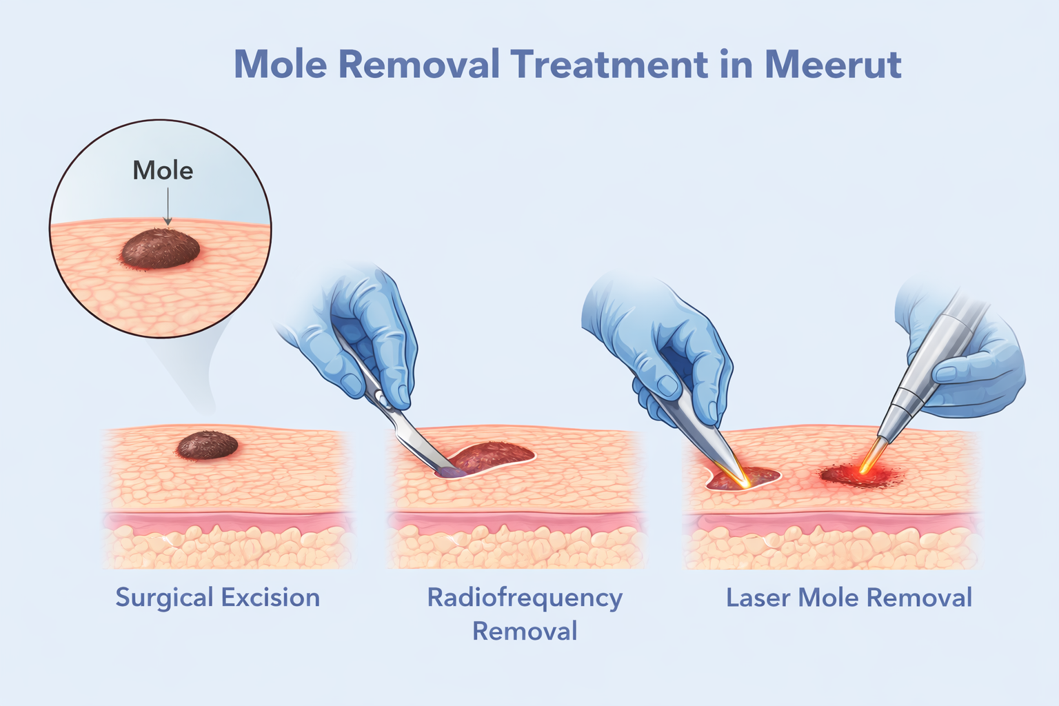 Mole Removal Treatment by “Best Plastic Surgeon in Meerut”